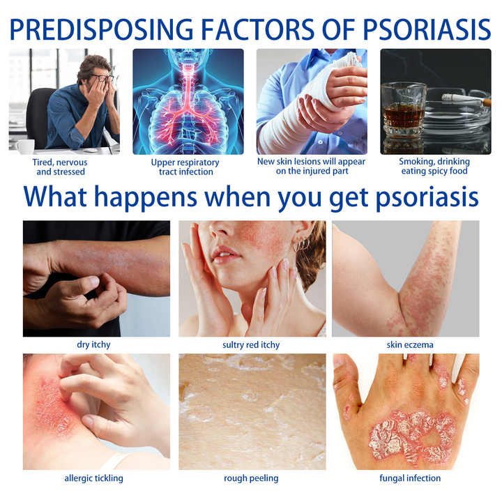 Pommade pour le Psoriasis