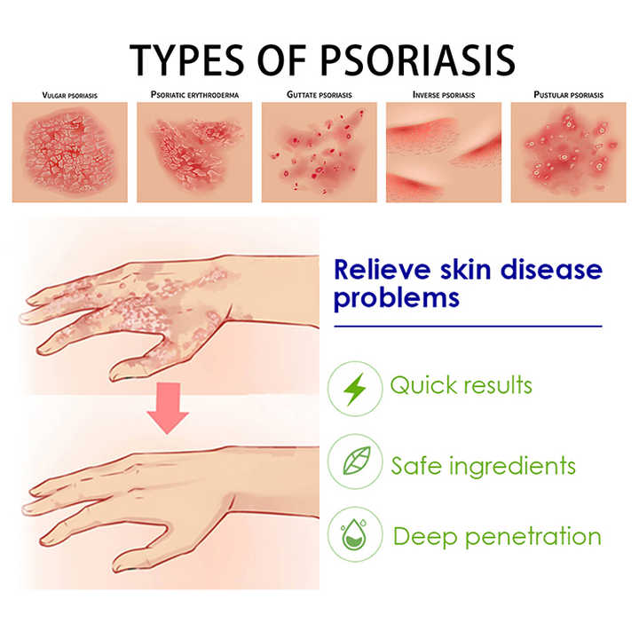 Pommade pour le Psoriasis