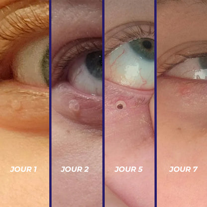 TagPal - Le kit anti-excroissances sans douleur