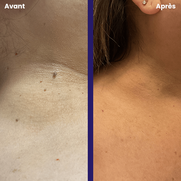 TagPal - Le kit anti-excroissances sans douleur