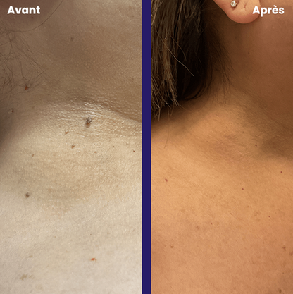 TagPal - Le kit anti-excroissances sans douleur