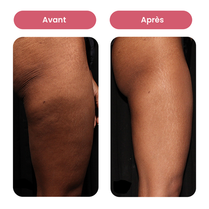 Masseur Anti-Cellulite Électrique