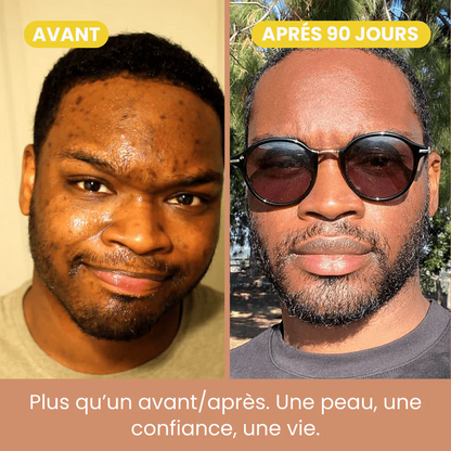 Pads Curcuma Anti-Taches – Peaux Noires & Métissées